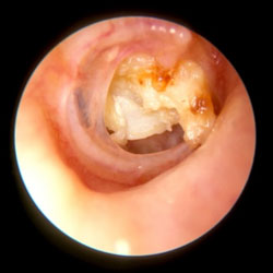 Mastoiditis symptoms child